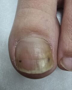 1онихолизис