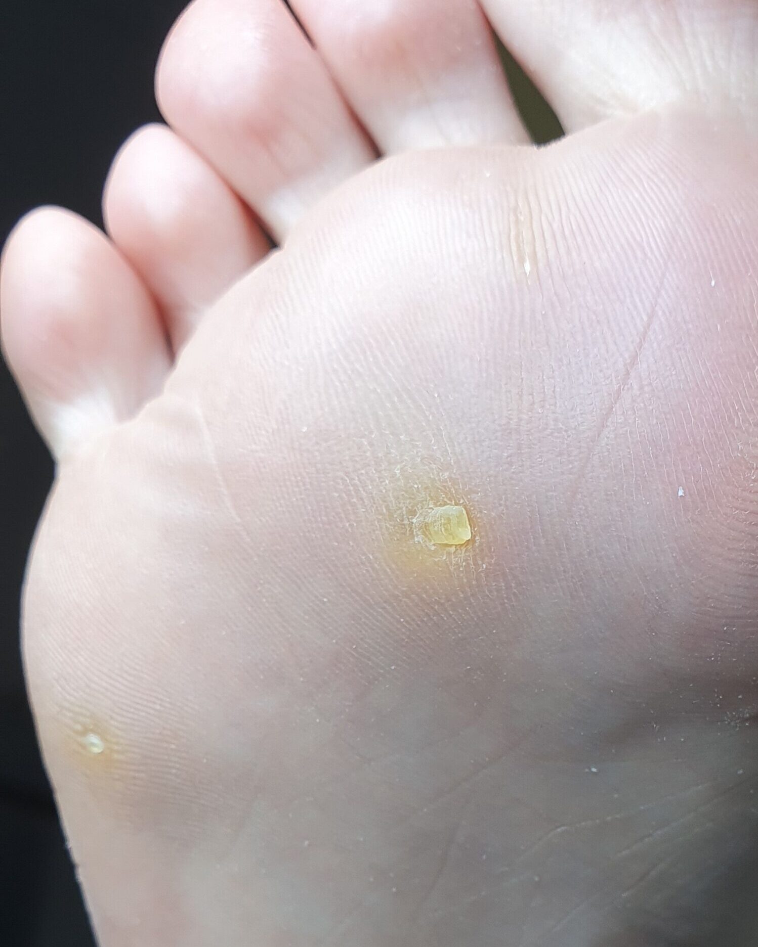 стержневая мозоль