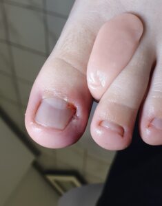 ортез при вросшем ногте