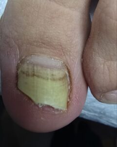 2онихолизис