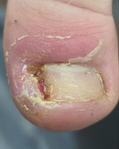 боковой валик болит