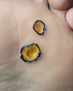 бородавки на стопе