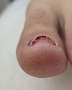 деформация ногтя