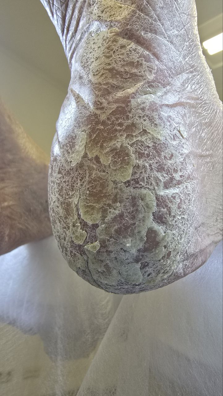 микоз стопы