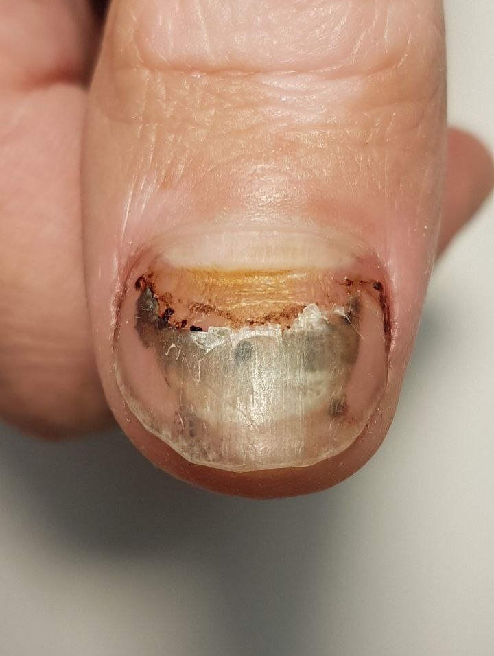 травма ногтя