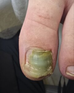 гематома под ногтем_равма