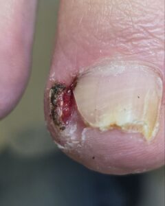 глубоко врос ноготь