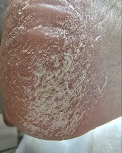 грибок на пятке