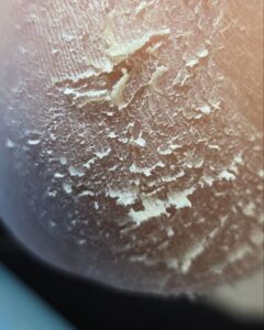 грибок на пятке перед обработкой