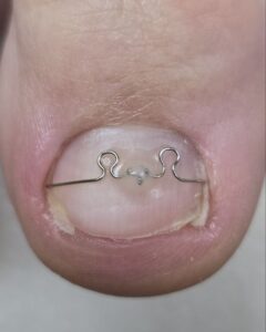 корсистема_тампонада