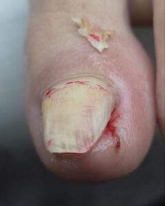 кусок вросшего ногтя