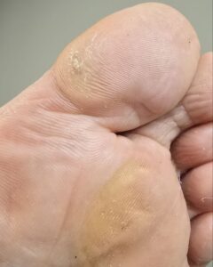 натоптыши на стопе