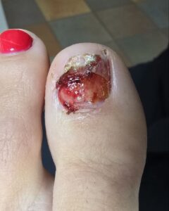 ноготь отбит