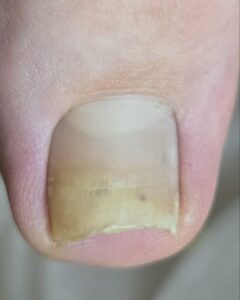 онихолизис