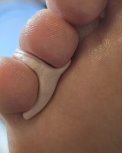 ортез между пальцами