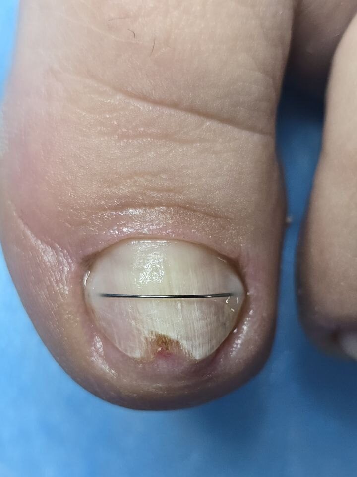 грибок на ногте зеленый_зачистка подологом_коррекционная система