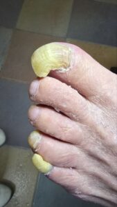 онихогрифоз