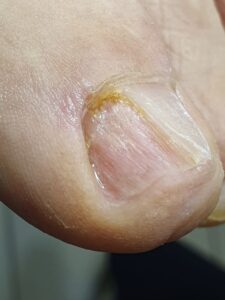 грибок ногтя запущенный_зачистка ногтя у подолога