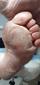 натоптыш на подошве