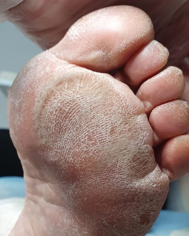 натоптыш на подошве