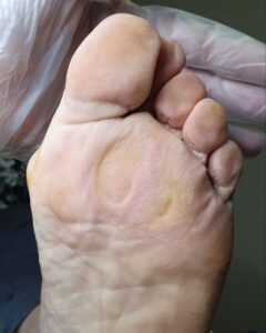 натоптыш под плюсной_обработанный