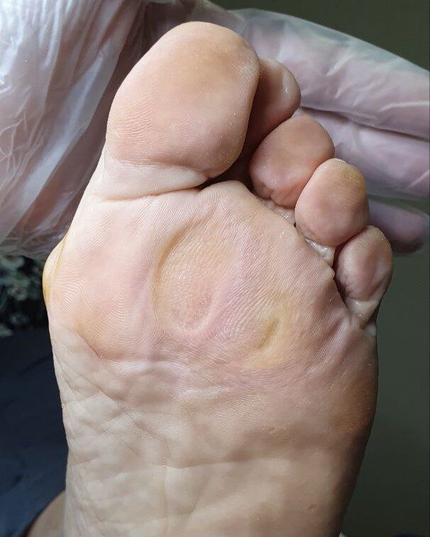 натоптыш под плюсной_обработанный