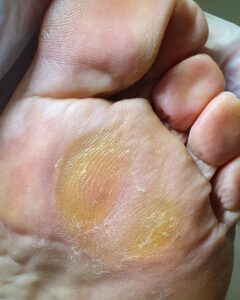 натоптыш под плюсной