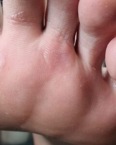 бородавка под пальцем_после обработки