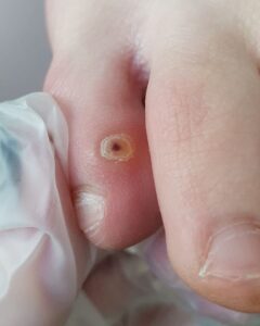 мозоль с черной точкой