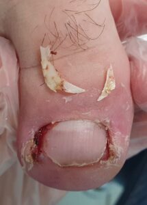 вырезать вросший ноготь_подолог