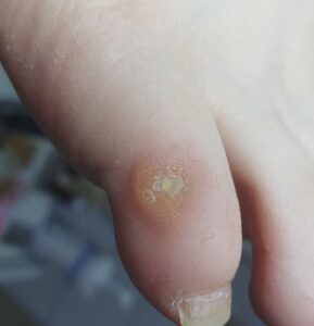 сухой мозоль на мизинце