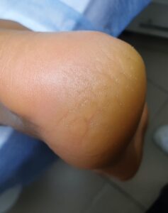 множественные трещины на пятке_обработка подолога