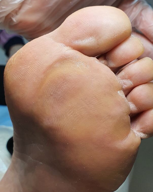 натоптыш на подошве_обработанный