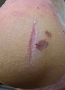 убрать трещины на пятке