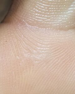 бородавка под пальце большая_обработанная