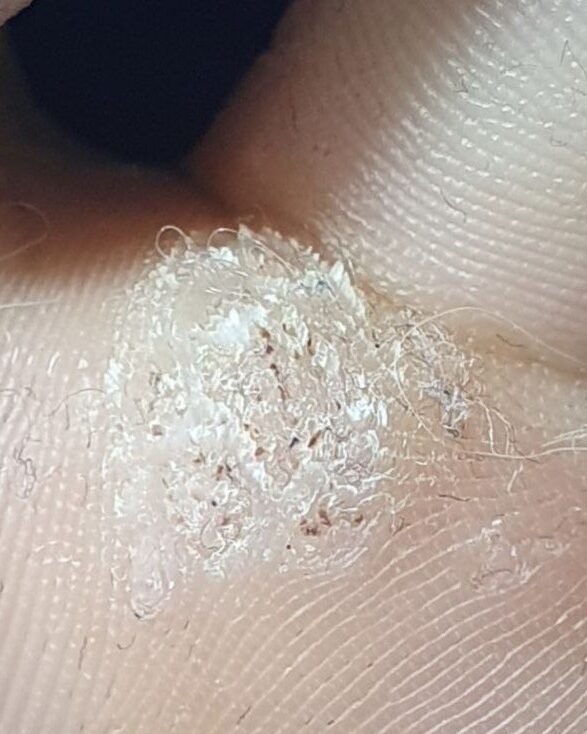 бородавка под пальце большая