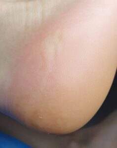 гиперкератоз и трещины_обработал подолог