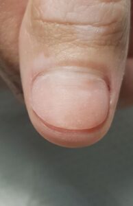 протезування нігтя