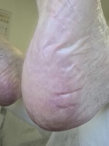 микоз стопы_зачистка у подолога