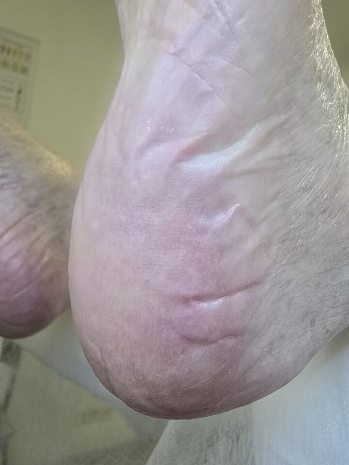 микоз стопы_зачистка у подолога