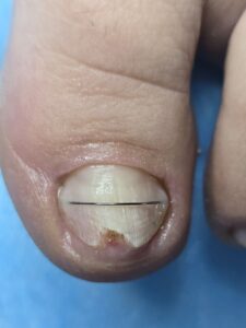 подологічна обробка грибка на нігтях