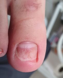 подологічна обробка грибків на нігтях