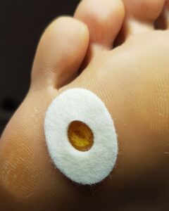 разрузка бородавки