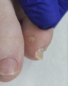 сухой мозоль между палами на мизинце