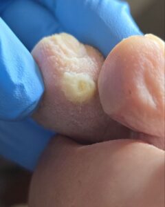 сухой мозоль на мизинце