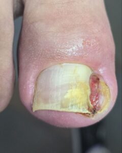 сильно врос ноготь