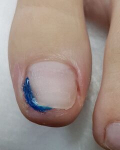 тампонада_вросший ноготь