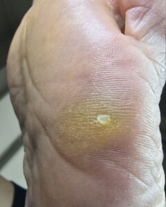 точечный мозоль