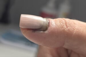 травма ногтя