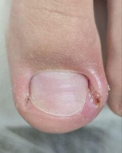 врос ноготь